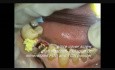 Implant Microsurgery: Replacing Retained Deciduous Molar