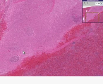 Spleen - Acute Infarct