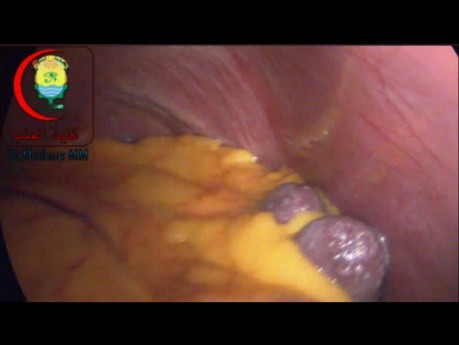 Cardiac Pulsation Left Subphrenic Adhesions Spleen White Dots