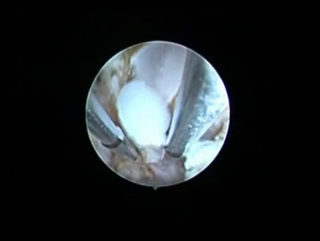 Endometrial ablation in adenomyosis II