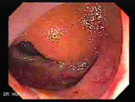 Invasive amebiasis and ameboma formation (4 of 4)