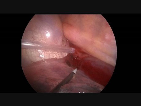 Minimally Invasive Esophagectomy for Cancer