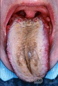 Coated Tongue