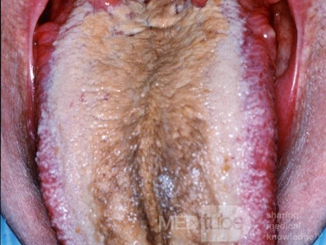 Coated Tongue