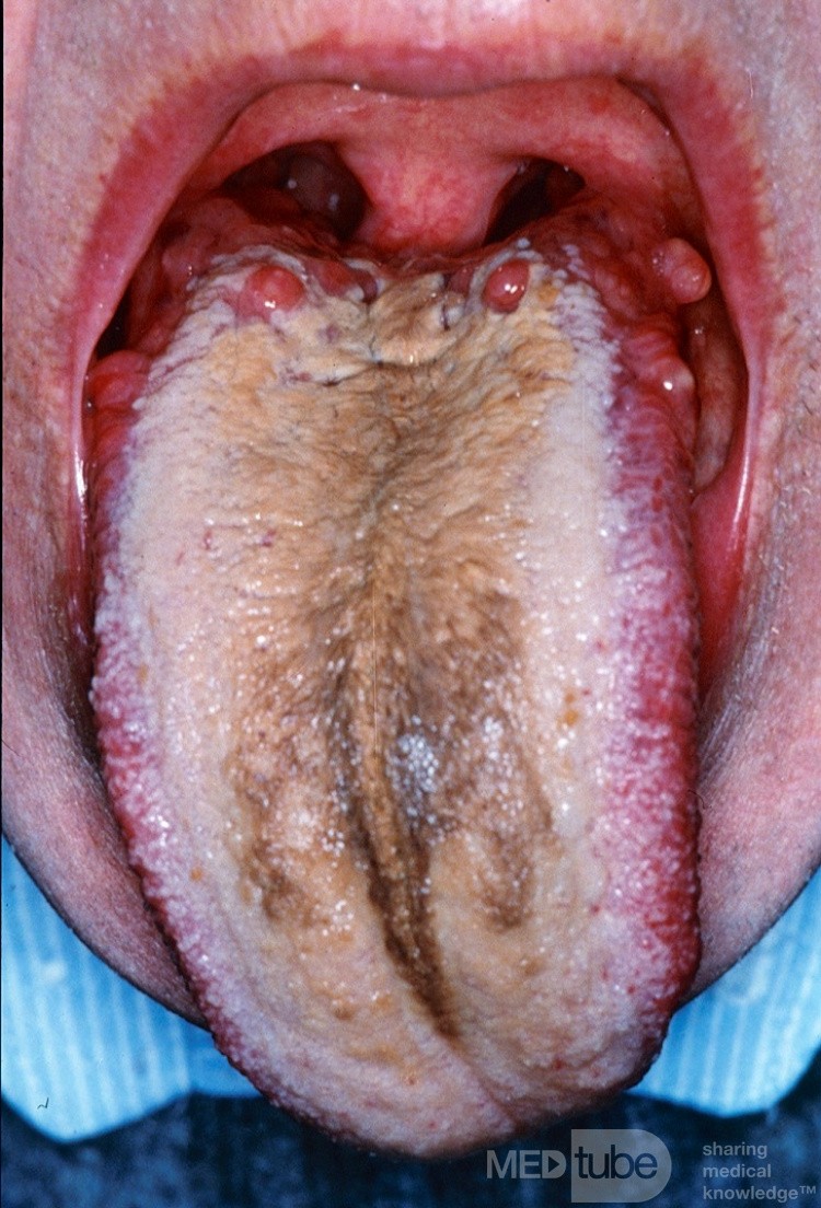 Coated Tongue