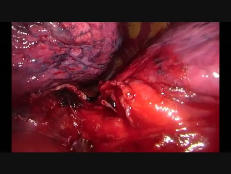 Subcostal Uniportal VATS Left Lower Lobectomy