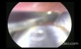 Long Sewing Needle (FB) in Penile Urethra