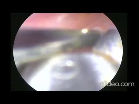 Long Sewing Needle (FB) in Penile Urethra