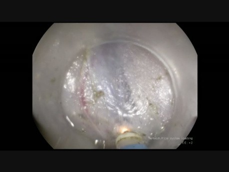 ESD of Large Rectal Polyp - Pocket Technique