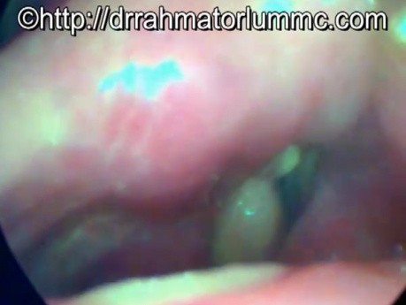 Right vocal fold detachment