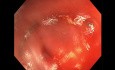 Prostatic Biopsy Bleeding - GI Tips