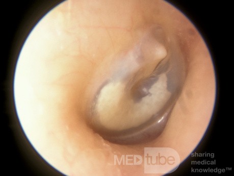 Tympanosclerosis