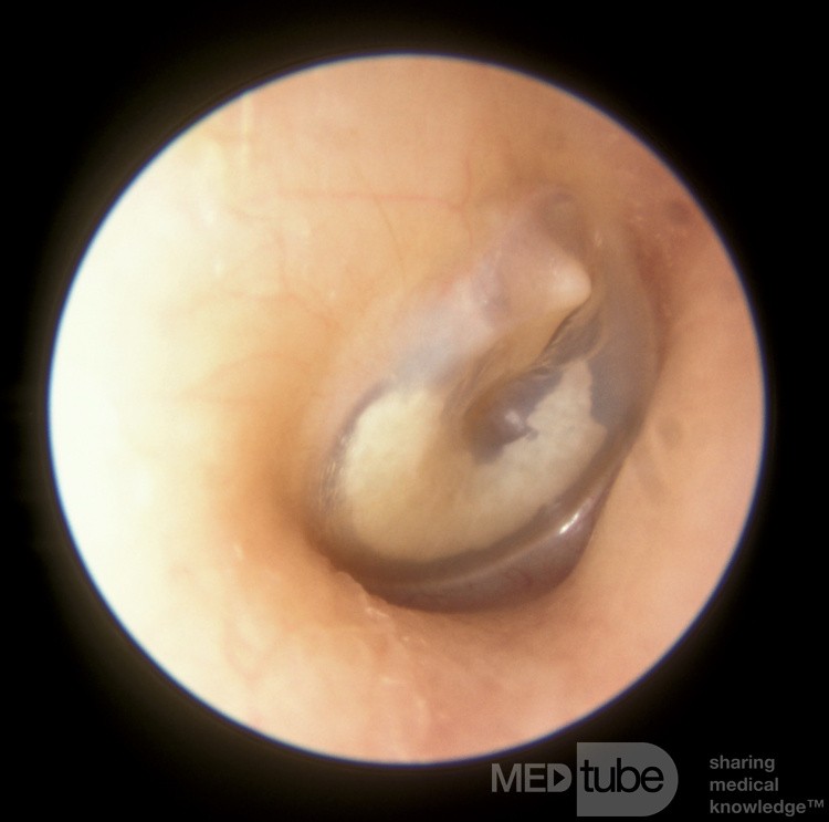 Tympanosclerosis