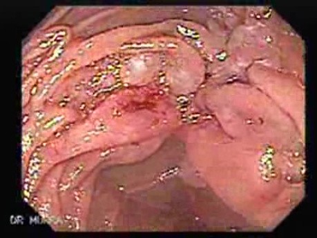 Gastric Lymphoma with Metastases to the Duodenum - Another Look at the Post-Bulbar Metastases
