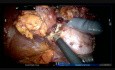 Robotic Regulated Multiple Kidney Tumor Resection