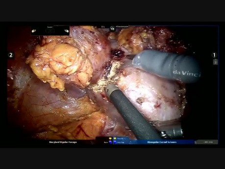 Robotic Regulated Multiple Kidney Tumor Resection