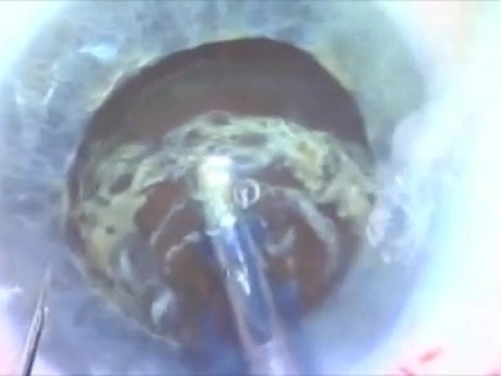 Multiple contrentric capsulotymy - an almost impossible maneuver 