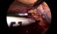Laparoscopic Repair of a Large Right Side Diaphragmatic Hernia