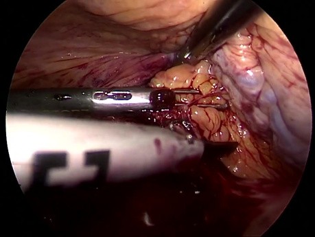 Laparoscopic Repair of a Large Right Side Diaphragmatic Hernia