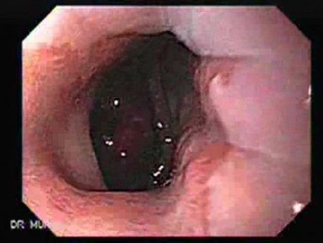 Early Gastric Cancer - Endoscopy (3 of 21)