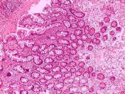 Intestinal Metaplasia of the Pre-Piloric Antrum. Chronic gastritis with intestinal metaplasia (2 of 3)
