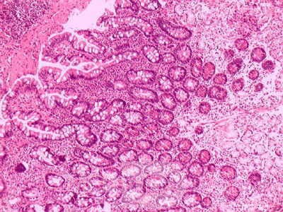 Intestinal Metaplasia of the Pre-Piloric Antrum. Chronic gastritis with intestinal metaplasia (2 of 3)