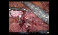 Robot Assisted Bi-Lobectomy for a Upper Lobe Tumour Invading the Middle Lobe