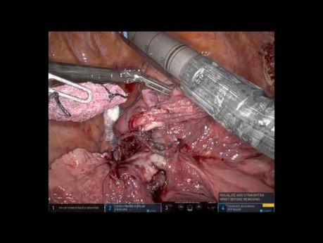 Robot Assisted Bi-Lobectomy for a Upper Lobe Tumour Invading the Middle Lobe
