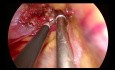 Uniportal VATS Resection of Apical Neurogenic Tumor at Thoracic Inlet
