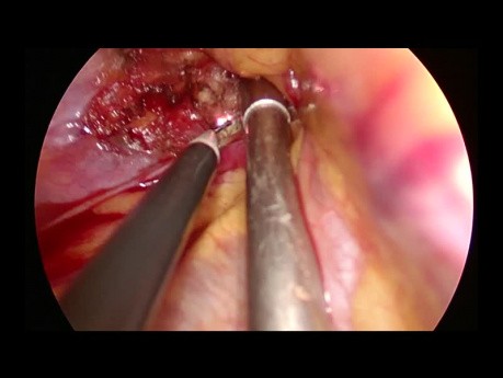 Uniportal VATS Resection of Apical Neurogenic Tumor at Thoracic Inlet