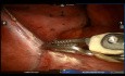 Robotic Lung Sequestration and Surgery