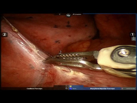 Robotic Lung Sequestration and Surgery