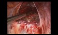 SELS - PreSacral Neurectomy