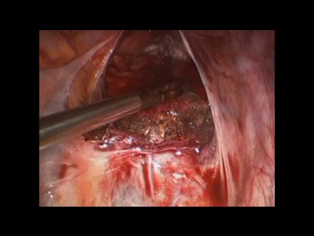 SELS - PreSacral Neurectomy