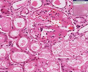 Kidney - Amyloidosis