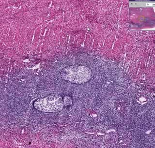 Brenner tumor - Histopathology of ovary