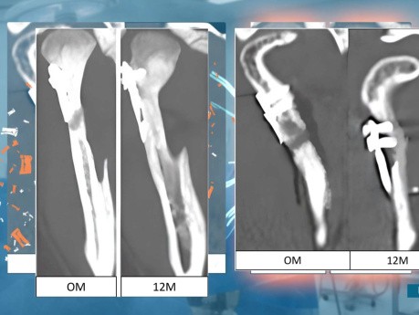 Osteosynthesis Results in Madibular Condyle Region