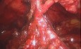 Laparoscopic Retossigmoidectomy for Haggit-IV Adenocarcinoma