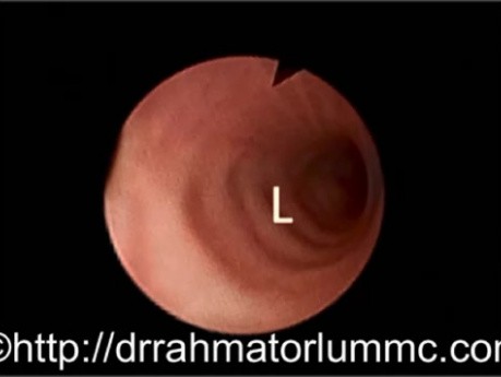 Bronchial Wall Contraction