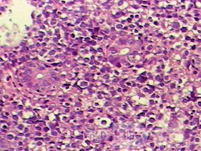 Non-Hodgkin's Lymphoma of the Colon (13 of 16)