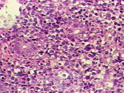 Non-Hodgkin's Lymphoma of the Colon (13 of 16)