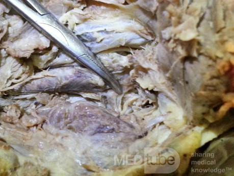Recurrent Laryngeal Nerve Forms
