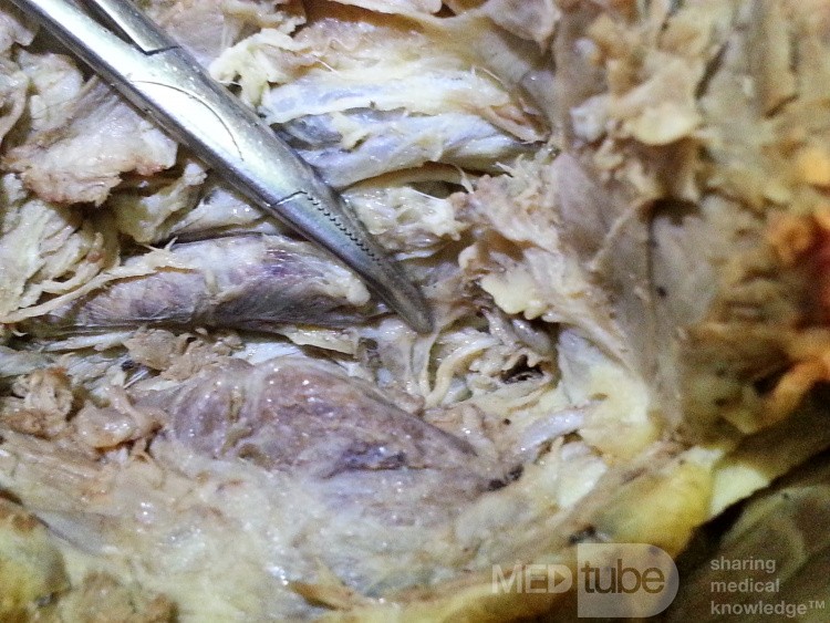 Recurrent Laryngeal Nerve Forms