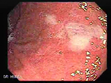 Systemic Lupus Erythematosus - Stomach finding (6 of 7)