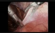 Laparoscopic Groin Hernia Repair Step 2: Right Peritoneal Incision