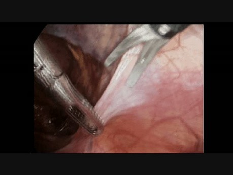 Laparoscopic Groin Hernia Repair Step 2: Right Peritoneal Incision