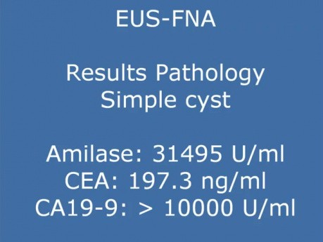 Technical aspects of EUS alcoholization of cystic tumor