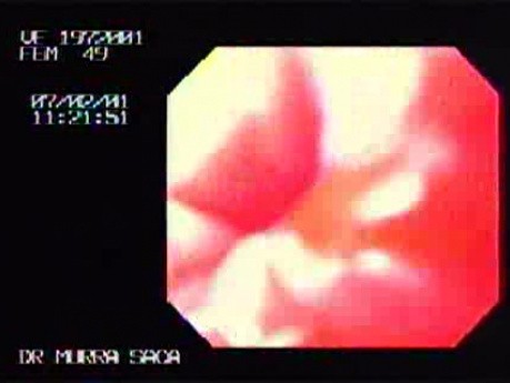 Endoscopic Image of Achalasia
