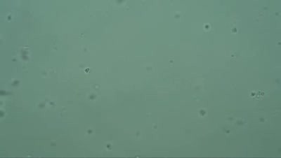 Infertility - Azoospermia