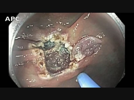 Colonoscopy - Ascending Colon - Flat Lesion - Step III - APC